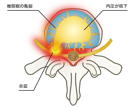 損傷した椎間板