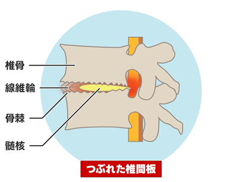 頚椎症
