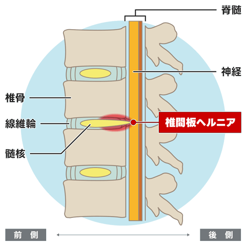 腰椎椎間板ヘルニアの原因