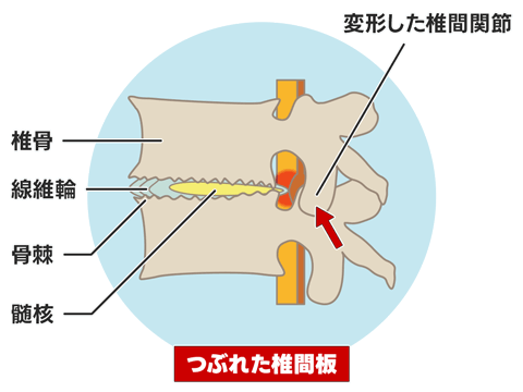 変形性腰椎症
